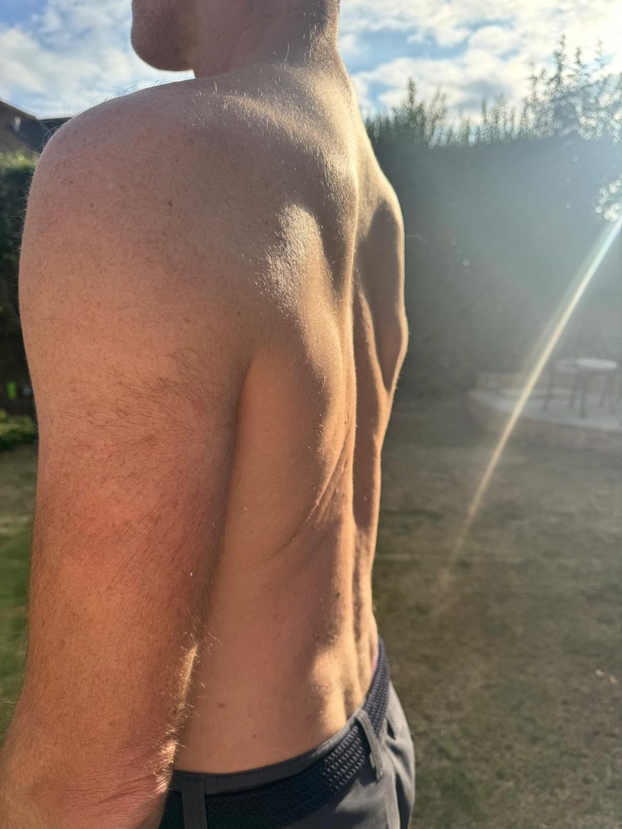 Bruce’s bare back photographed from behind and to the side in a sunny garden, showing a straight spine with almost no curve